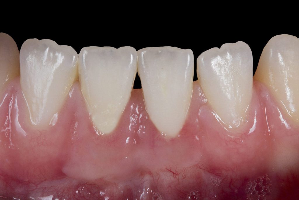 After: Root covered, frenum attachment fixed, thick strong gums resistant to injury