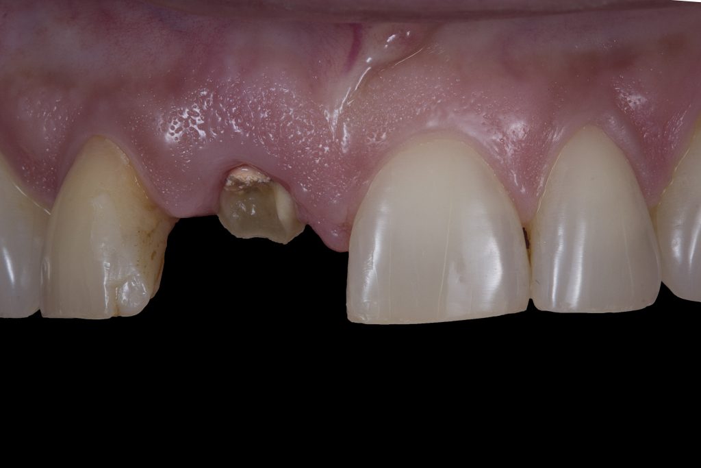 Before: Broken tooth