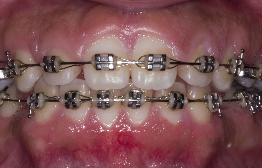 After: Esthetic crown lengthening complete, teeth are now normal length and shape