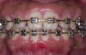 Lower teeth uncovered after crown lengthening