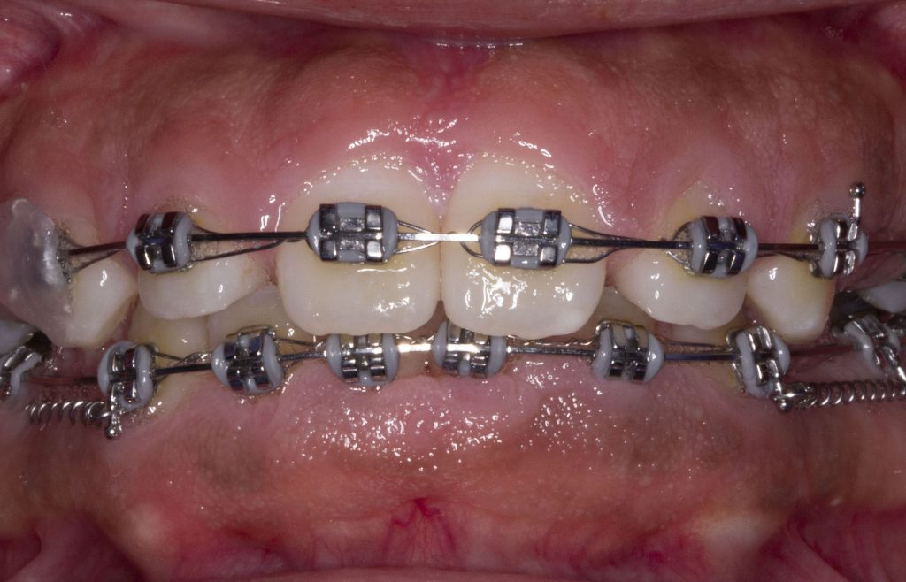 Before: Gingival overgrowth on lower teeth (too much gums covering teeth)