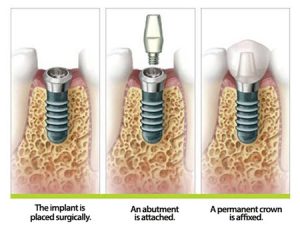 Schematic of dental implant timeline.