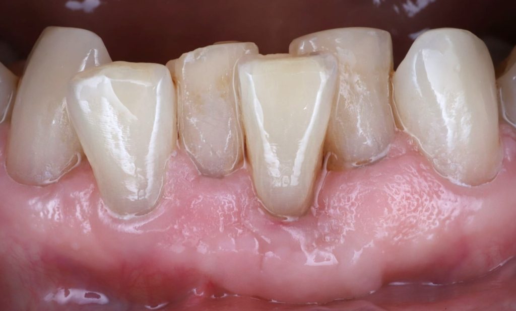 After: Root has been covered with thick, durable gums recession to recession.