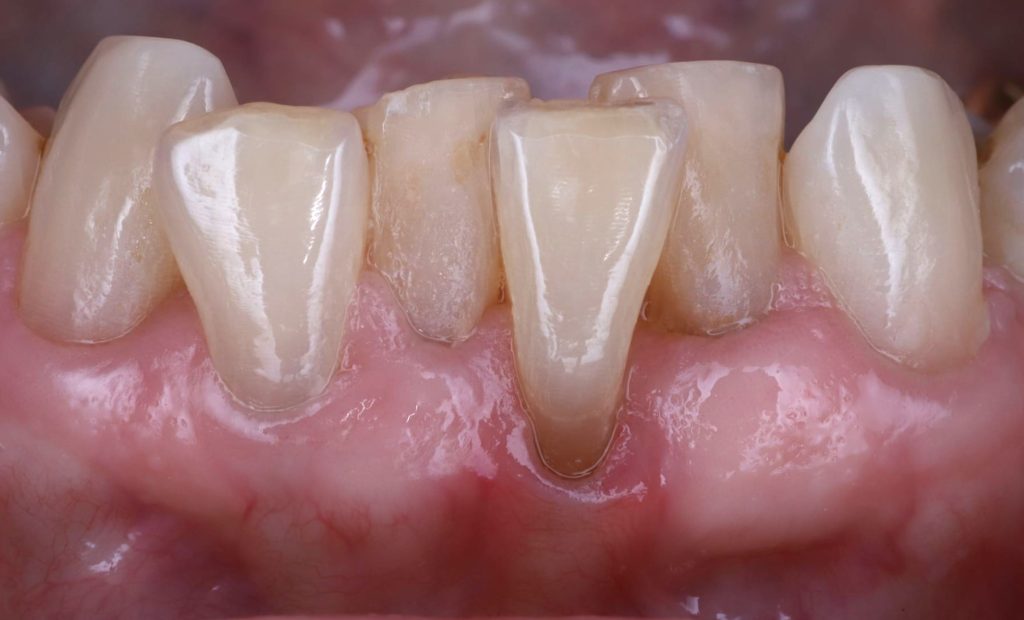 Before: Recession, root exposure, thin delicate gums, with tooth malposition