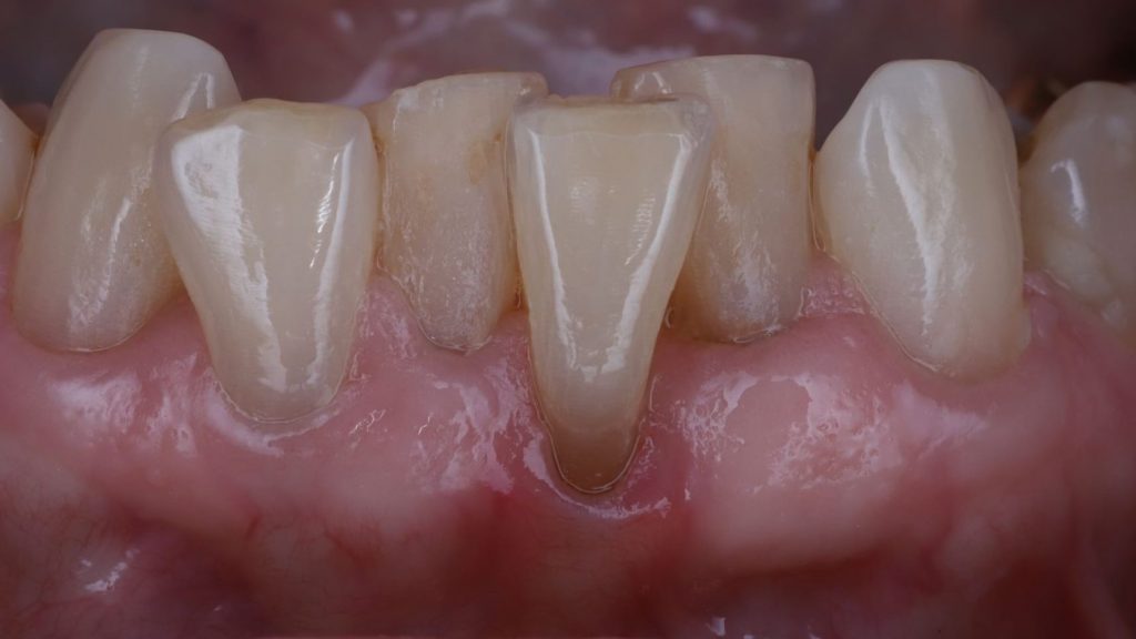 Before: Thin tissue with gum recession, dark root, and tooth malposition.