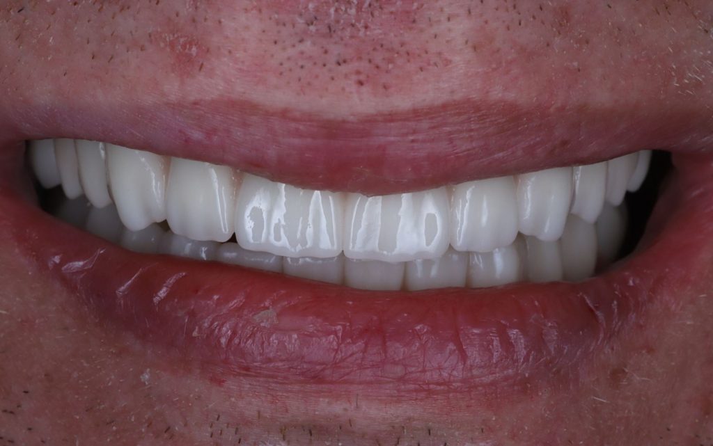 After: All teeth removed, implants placed, and restoration attached to implants all in the same day.
