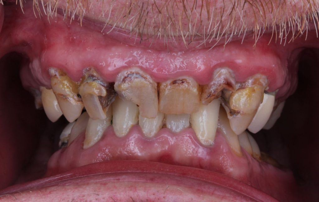Before: Full mouth of decayed and infected teeth. Painful and unable to eat or live comfortably.
