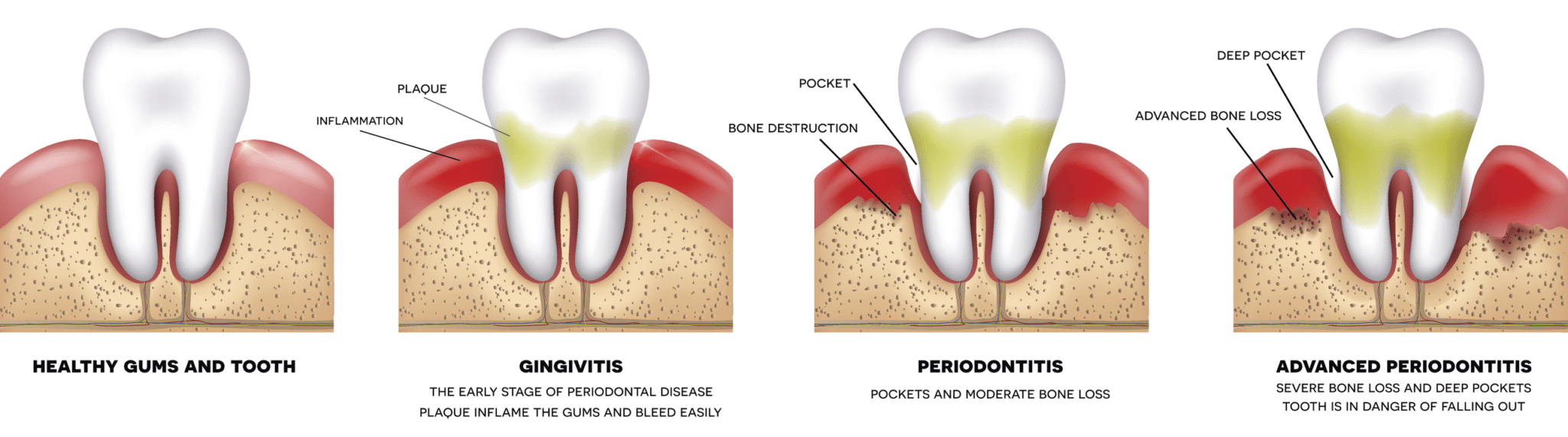 Periodontal Disease Treatment - Orange Periodontics And Dental Implantology